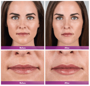 before and after lip augmentation photo