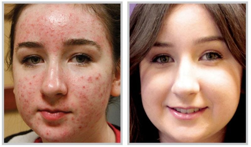 before and after BBL acne treatment