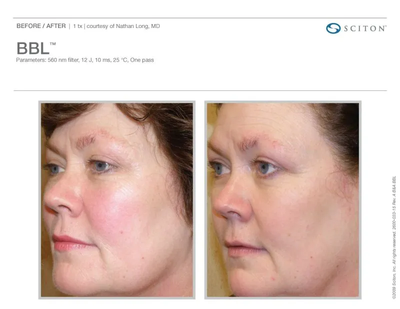 before and after rosacea treatments