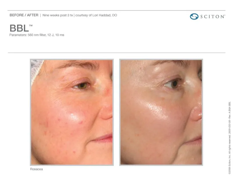 before and after rosacea treatments