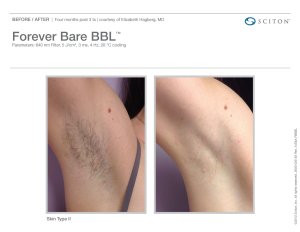 Forever Bare BBL Laser Hair Reduction