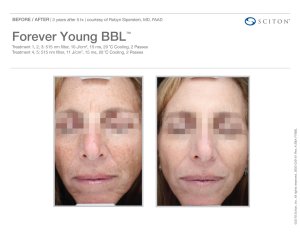 before and after BBL treatment