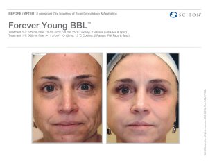 before and after BBL treatment