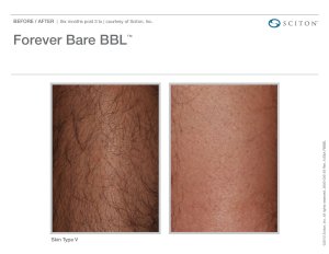 before and after laser hair reduction