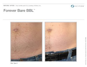 before and after laser hair reduction