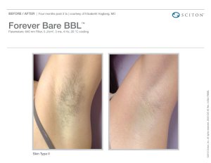 before and after laser hair reduction