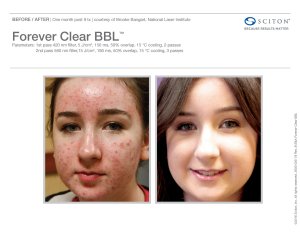 before and after BBL acne treatment