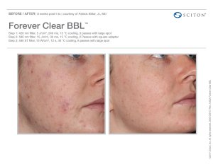 before and after BBL acne treatment
