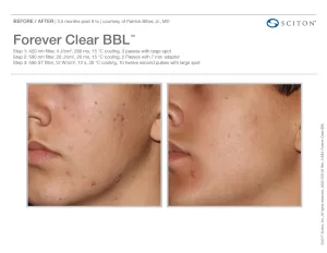 before and after BBL acne treatment