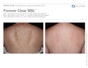 before and after BBL acne treatment
