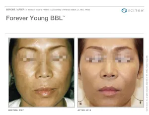 before and after BBL treatment