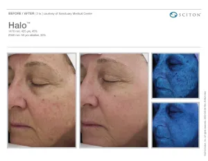 before and after halo laser