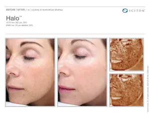 before and after halo laser