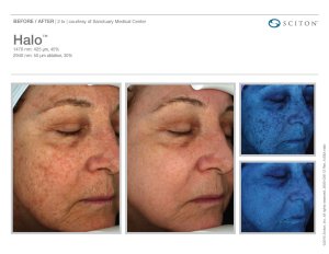 before and after halo laser
