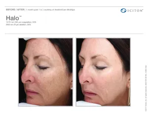 before and after halo laser