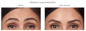 before and after botox photos