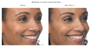 before and after botox photos
