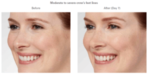 before and after botox photos