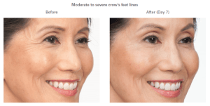 before and after botox photos