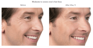 before and after botox photos