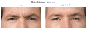 before and after botox photos