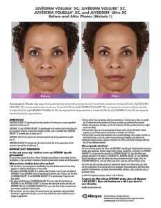 fillers article