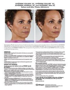 fillers article