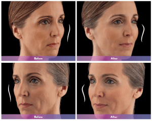 before and after photos of fillers