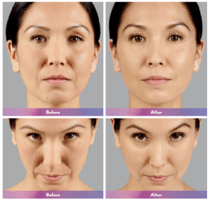 before and after photos of fillers
