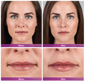 before and after lip augmentation photo