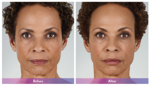before and after photos of fillers