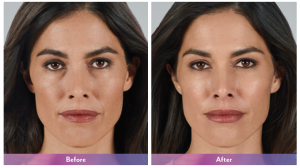 before and after photos of fillers