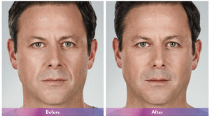 before and after photos of fillers