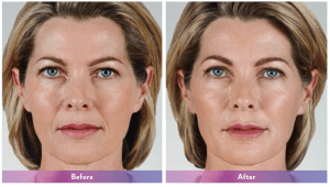 before and after photos of fillers