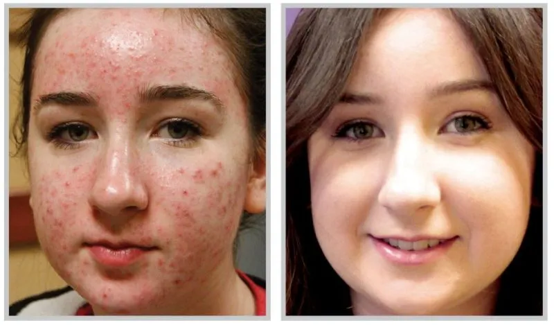 before and after BBL acne treatment