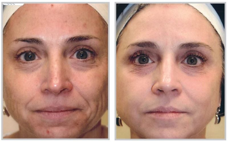 before and after BBL treatment