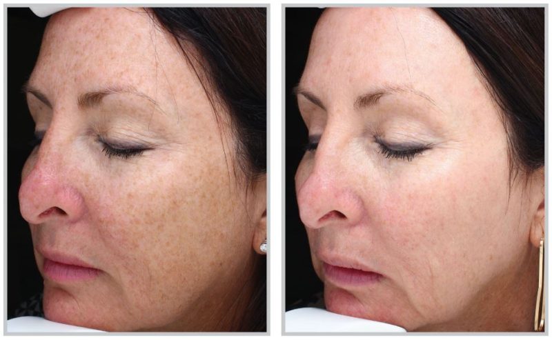 before and after halo laser