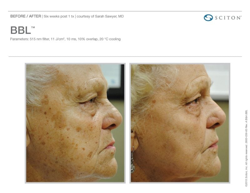 before and after age spot removal on face