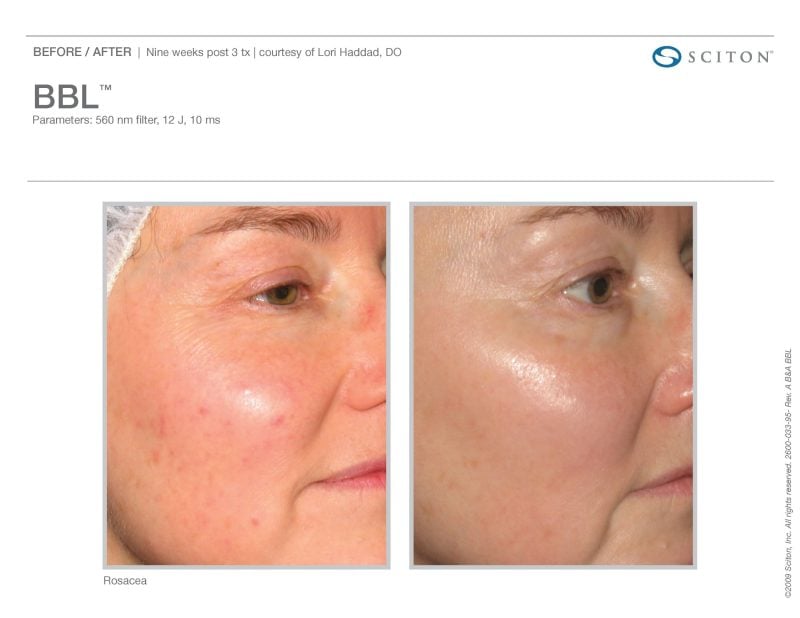 before and after rosacea treatments