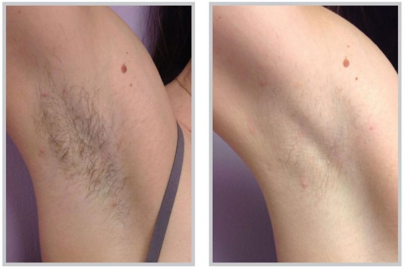 before and after laser hair reduction