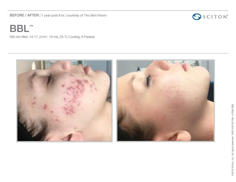 face with acne
