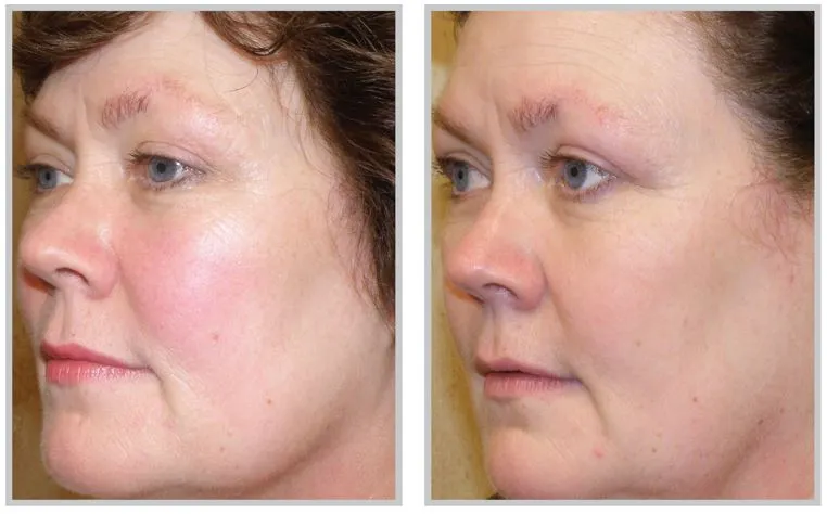 before and after rosacea treatments