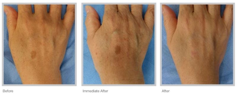 before and after age spot removal on hand