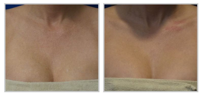 Photo of upper chest before and after skin rejuvenation