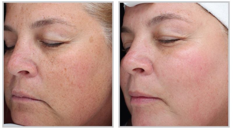 Photo of a female face before and after skin rejuvenation