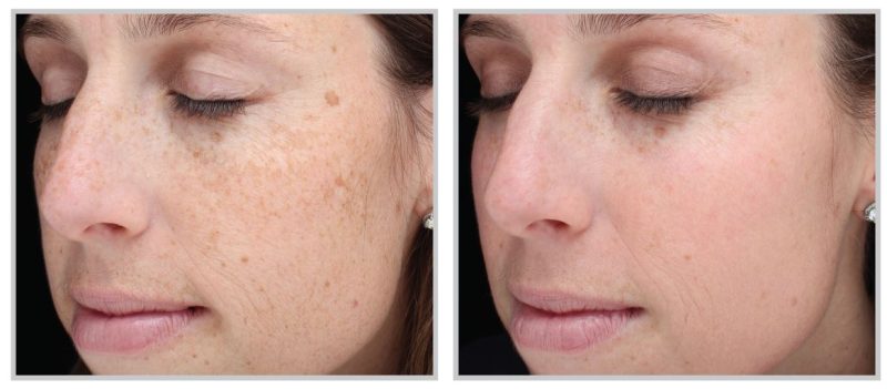 Photo of a female face before and after skin rejuvenation