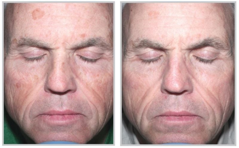 Photo of a male face before and after skin rejuvenation